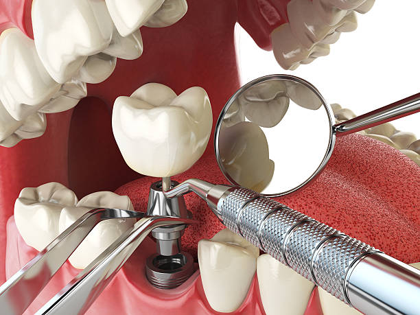Best Emergency Treatment for Dental Infections or Abscesses in Linden, NJ